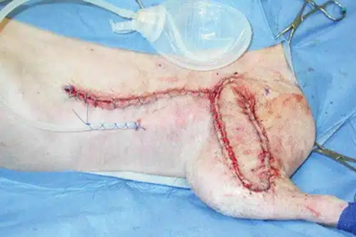 2084-Wound-Reconstruction