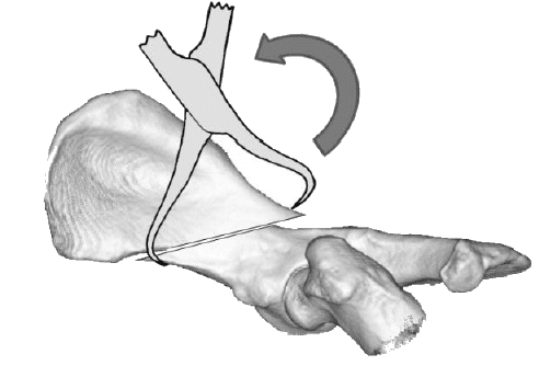 ilial shaft reduction