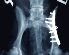 pelvic fracture example